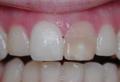 दांत काले क्यों हो गए: तामचीनी के बाहर और अंदर, जड़ पर और भरने के नीचे काले होने का कारण दांत में भरना काला क्यों हो गया