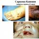 sarcoma ของ Kaposi ที่เป็นอันตราย: มีโอกาสรอดหรือไม่?